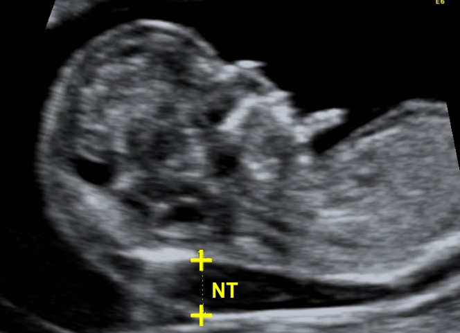 NT Scan (Nuchal Translucency) - Between 11w - 13w 6d